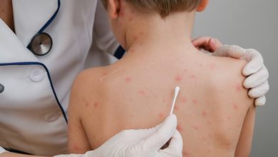 Photo of ALERTA SARAMPIÓN: crecen los CASOS y la PREOCUPACIÓN en ARGENTINA