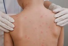 Photo of ALERTA EPIDEMIOLÓGICA ANTE LA PERSISTENCIA DE SARAMPIÓN