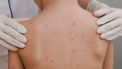 Photo of ALERTA EPIDEMIOLÓGICA ANTE LA PERSISTENCIA DE SARAMPIÓN